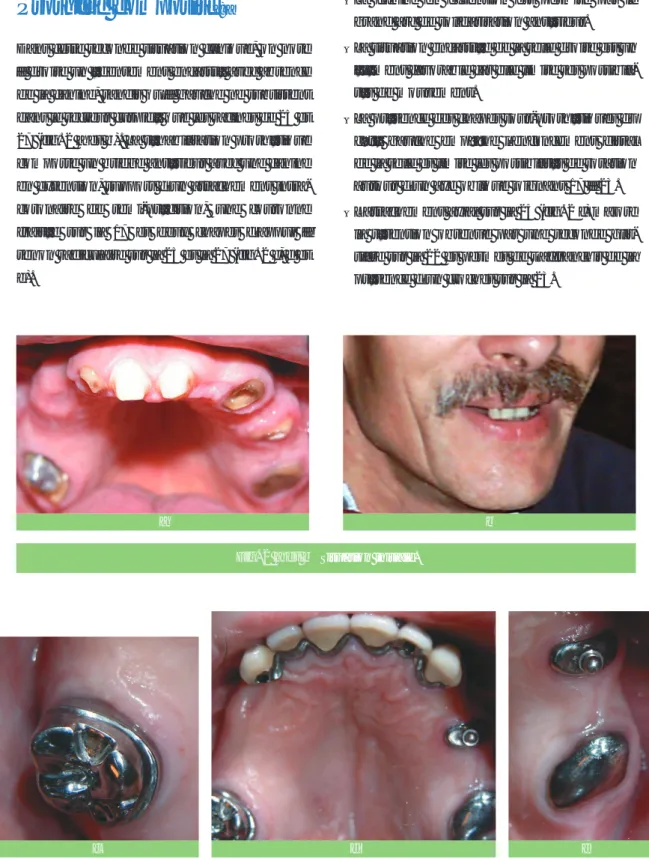 Fig. 2 c, d et e Éléments de prothèse fixée.