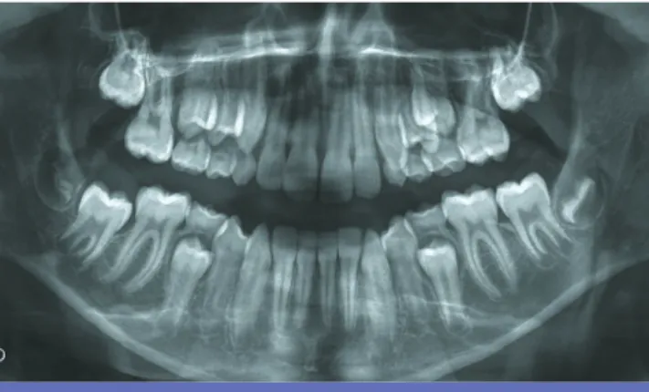 Fig. 6 Radiographie panoramique réalisée chez un garçon âgé de 11 ans montrant l’évolution normale des canines maxillaire permanentes.