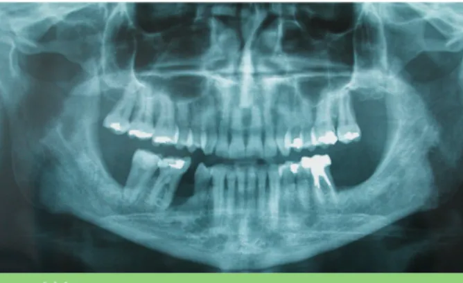 Fig. 10 Contrôle radiographique à 6 mois post-opéra- post-opéra-toire : absence de nouvelle localisation.