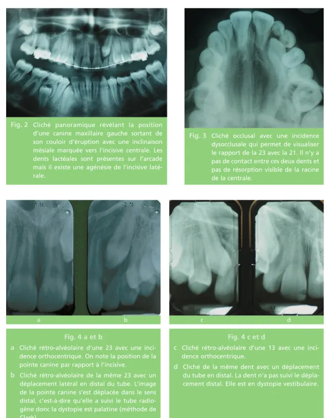 Fig. 2 Cliché panoramique révélant la position d’une canine maxillaire gauche sortant de son couloir d’éruption avec une inclinaison mésiale marquée vers l’incisive centrale