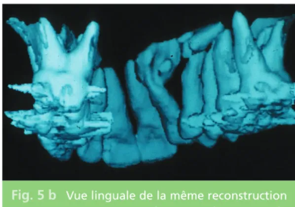 Fig. 5 b Vue linguale de la même reconstruction 3D permettant de préciser la position de 13 par rapport à l’incisive latérale.