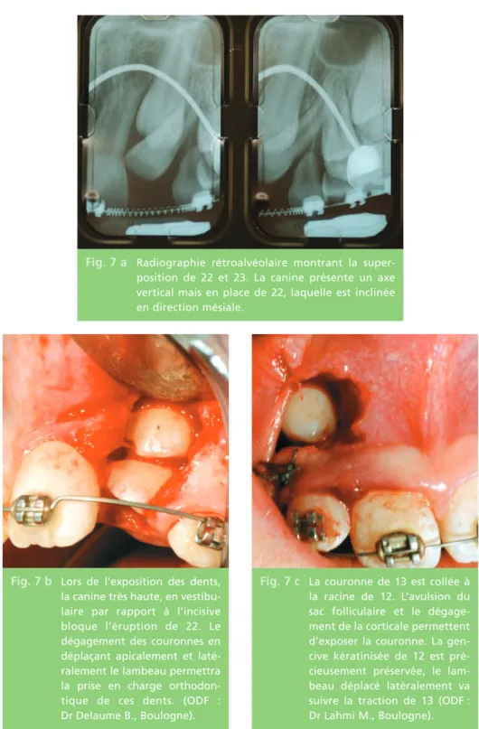 Fig. 7 a Radiographie rétroalvéolaire montrant la super- super-position de 22 et 23. La canine présente un axe vertical mais en place de 22, laquelle est inclinée en direction mésiale.