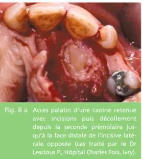 Fig. 8 b La mise en place d’un pansement parodon- parodon-tal permet de préserver le dégagement et d’éviter un retour muqueux