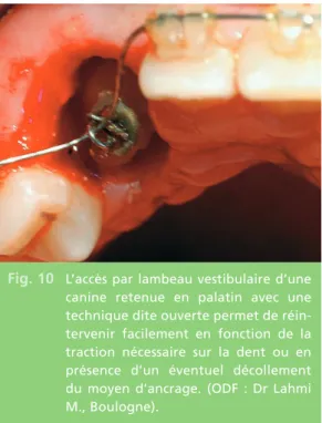 Fig. 10 L’accès par lambeau vestibulaire d’une canine retenue en palatin avec une technique dite ouverte permet de  réin-tervenir facilement en fonction de la traction nécessaire sur la dent ou en présence d’un éventuel décollement du moyen d’ancrage