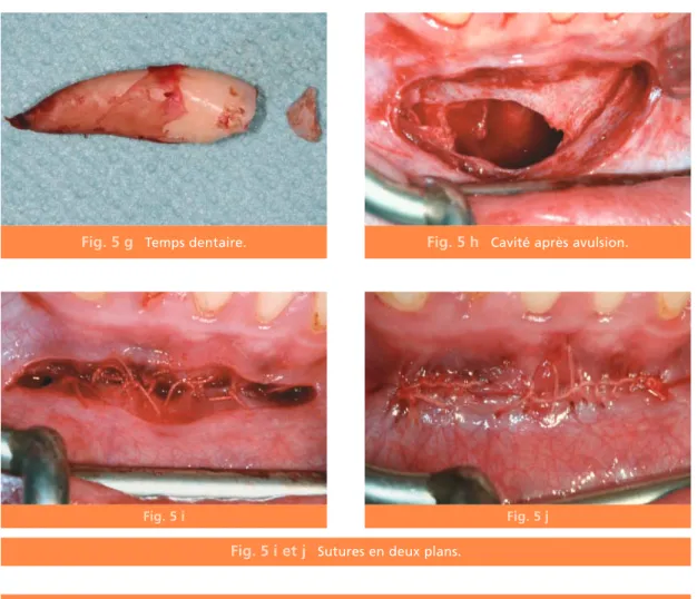 Fig. 5 g Temps dentaire. Fig. 5 h Cavité après avulsion.