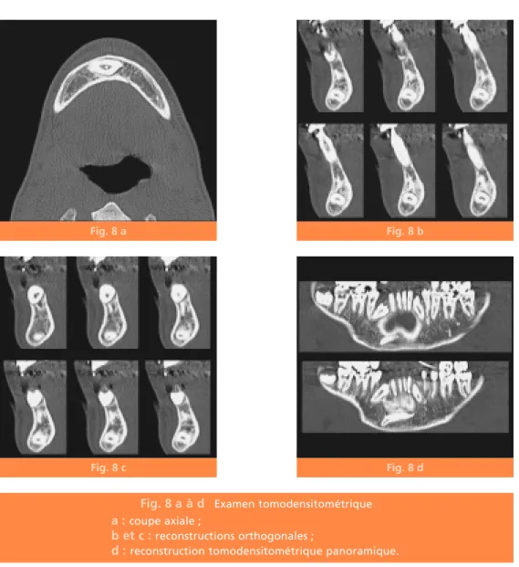 Fig. 8 a à d Examen tomodensitométrique a : coupe axiale ;