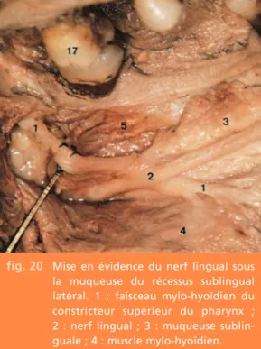 fig. 22 Coupe frontale du corps de la mandibule passant par la 38. On remarque la  proxi-mité du canal mandibulaire avec la corticale linguale.