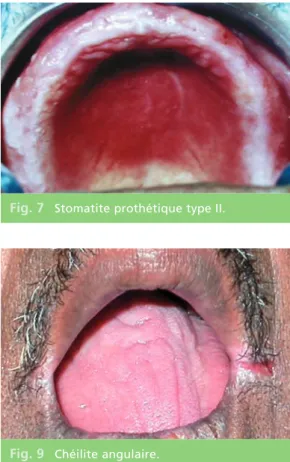 Fig. 6 Stomatite prothétique type I.