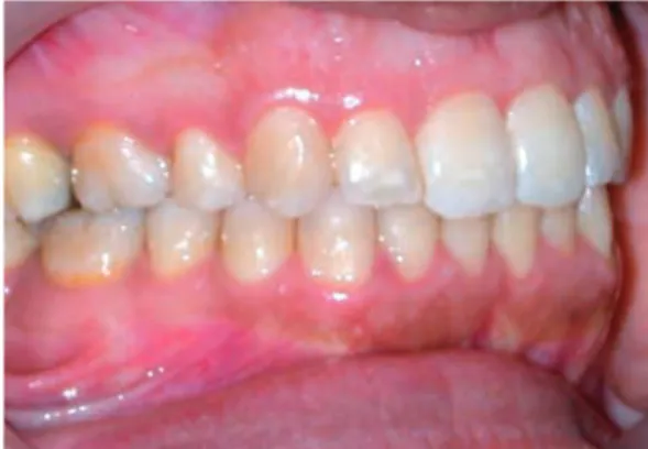 Fig. 6 Occlusion de classe II thérapeutique après extraction mono maxillaire de  14-24.