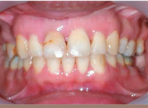 Fig. 7 Extraction d’une incisive mandibulaire chez l’adulte.