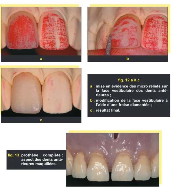 fig. 13 prothèse complète : aspect des dents  anté-rieures maquillées.