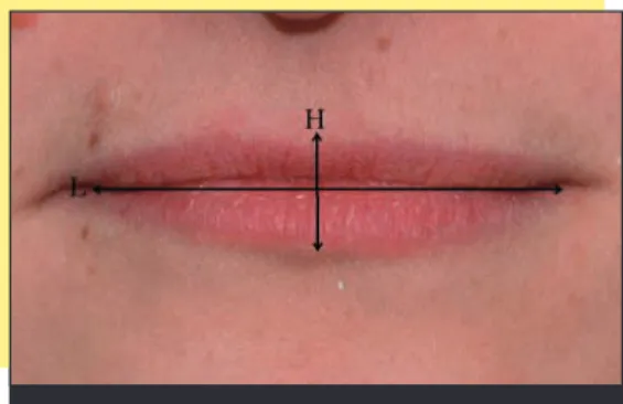fig. 5 Dimension des lèvres 4H = L.