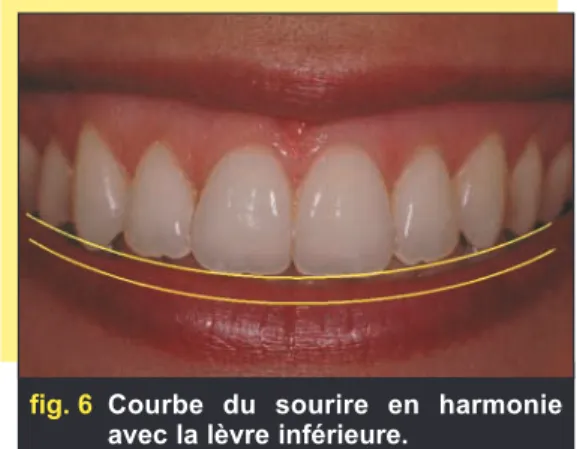 fig. 6 Courbe du sourire en harmonie avec la lèvre inférieure.