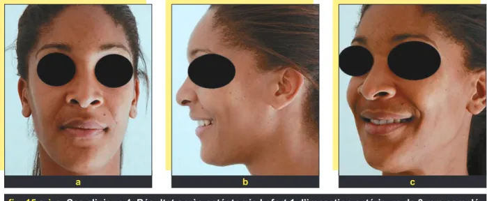 fig. 15 a à c Cas clinique 4. Résultat après ostéotomie Lefort 1 d’impaction antérieure de 8 mm complé- complé-tée d’une ostéotomie sagittale d’avancée mandibulaire qui permet la correction du sourire gingival