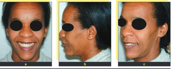fig. 12 a à c Cas clinique 3. Correction partielle du sourire gingival après ostéotomie de Wassmund, ouverture de l’angle nasolabial avec correction de la prochéilie et meilleure projection du menton.