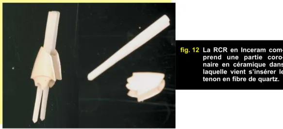 fig. 11 Reconstitution coronaire au composite photopolymérisable, puis rectification de la taille.