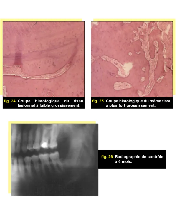 fig. 26 Radiographie de contrôle à 6 mois.