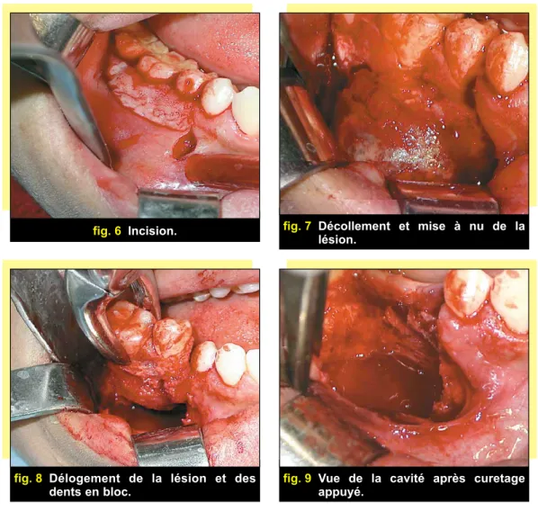 fig. 6 Incision.