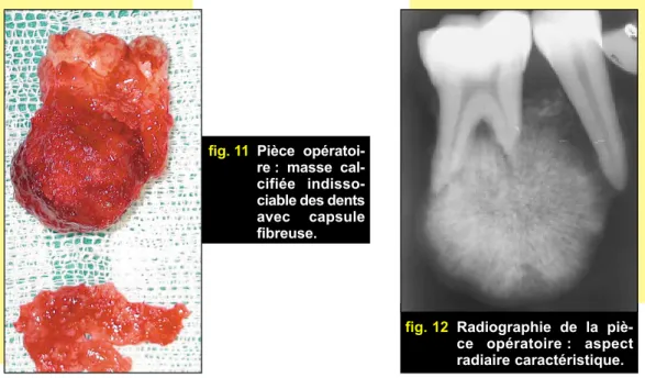 fig. 10 Sutures.