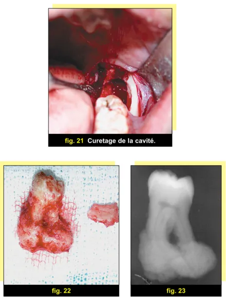 fig. 22 fig. 23fig. 21Curetage de la cavité.