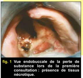 fig. 1 Vue endobuccale de la perte de substance lors de la première consultation : présence de tissus nécrotique.