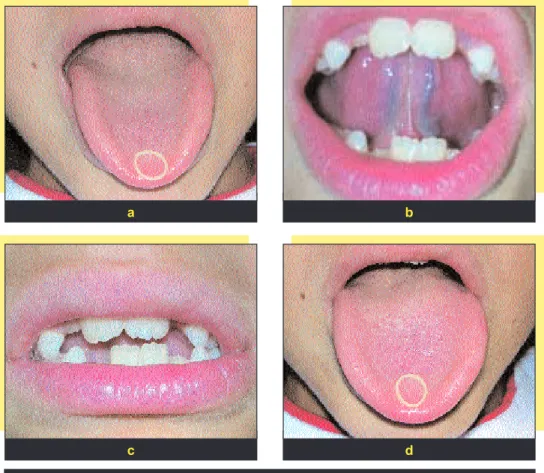 fig. 13 a à d Exercices de la déglutition : l’enfant doit déglutir pointe de la langue contre le palais sans perdre l’élastique.