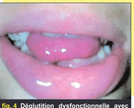 fig. 4 Déglutition dysfonctionnelle avec interposition linguale antérieure.