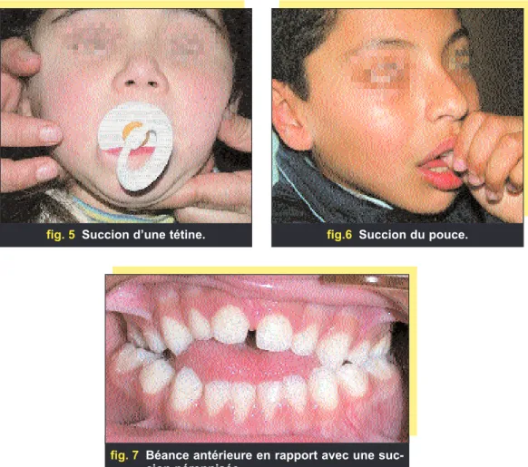 fig. 5 Succion d’une tétine.