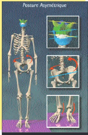 fig. 7 Décompensation transversale.