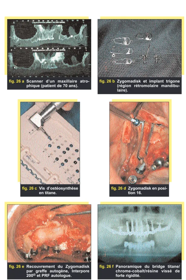 fig. 26 a Scanner d’un maxillaire atro- atro-phique (patient de 70 ans).