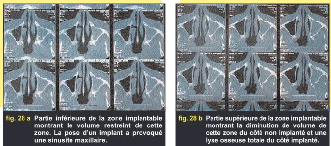 fig. 28 b Partie supérieure de la zone implantable montrant la diminution de volume de cette zone du côté non implanté et une lyse osseuse totale du côté implanté.