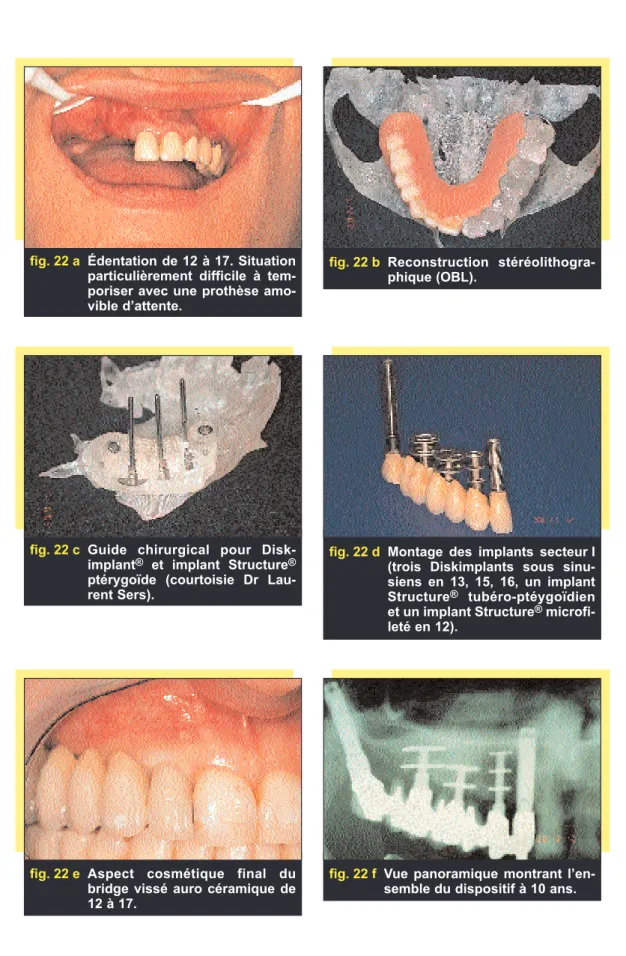 fig. 22 a Édentation de 12 à 17. Situation particulièrement difficile à  tem-poriser avec une prothèse  amo-vible d’attente.