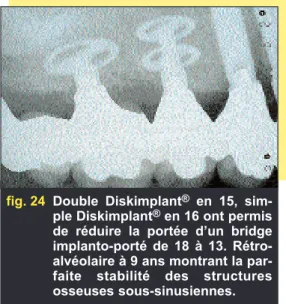 fig. 23 Implantation secteur 1. 12 et 13 sont présentes. Triple disque en 14, double disque en 15 et simple disque en 16