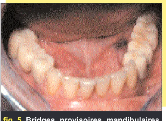 fig. 5 Bridges provisoires mandibulaires reconstitués à partir des cires de diagnostic.