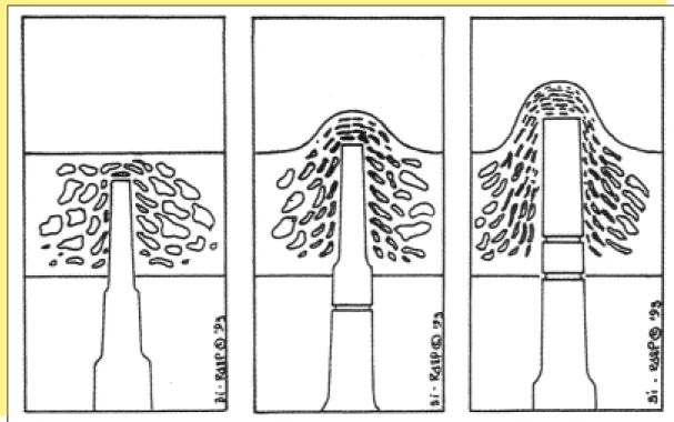 fig. 9 Refoulement de l’os en direction du sinus maxillaire (d’après Summers).