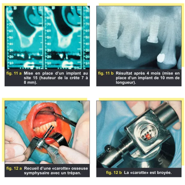 fig. 11 a Mise en place d’un implant au site 15 (hauteur de la crête 7 à 8 mm).