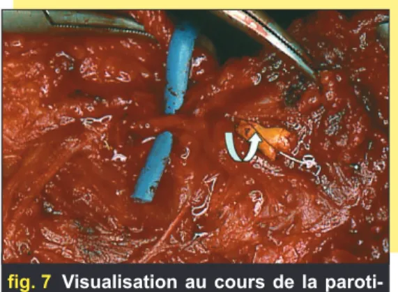 fig. 7 Visualisation au cours de la paroti- paroti-dectomie de la sonde à panier  blo-quée dans le bassinet de la glande.
