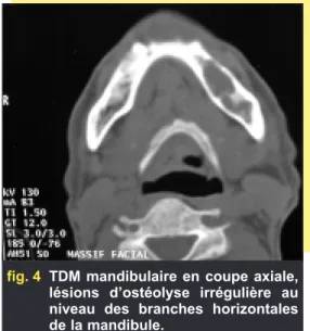 fig. 4 TDM mandibulaire en coupe axiale, lésions d’ostéolyse irrégulière au niveau des branches horizontales de la mandibule.