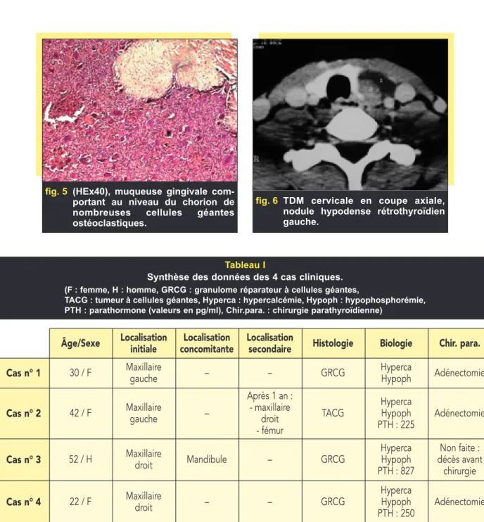 fig. 6 TDM cervicale en coupe axiale, nodule hypodense rétrothyroïdien gauche.