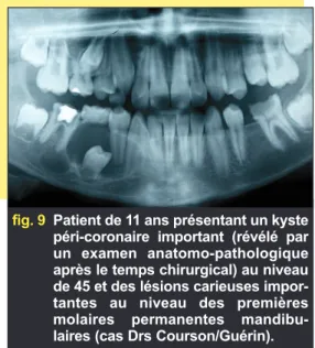 fig. 10 Le même patient, 18 mois plus tard, le germe de 45 et la 46 n’ont pu être conservés.