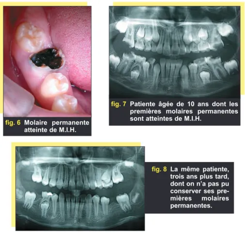 fig. 8 La même patiente, trois ans plus tard, dont on n’a pas pu conserver ses  pre-mières molaires permanentes.
