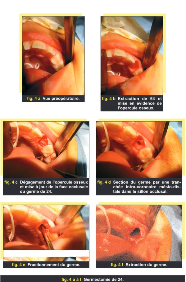 fig. 4 a Vue préopératoire. fig. 4 b Extraction de 64 et mise en évidence de l’opercule osseux.