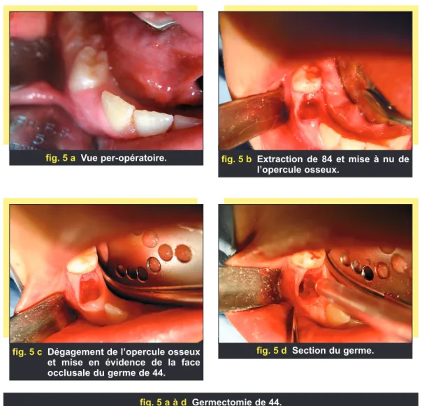 fig. 5 a Vue per-opératoire. fig. 5 b Extraction de 84 et mise à nu de l’opercule osseux.