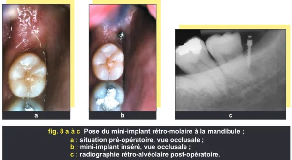 fig. 7 a à c Traitement de l’ingression de la 26 ; a : vue de la ligature élastique vestibulaire au début du traitement ;