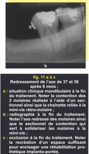 fig. 12 Radiographie de la phase termi- termi-nale. Pose de 2 implants dans l’espace postérieur recréé.