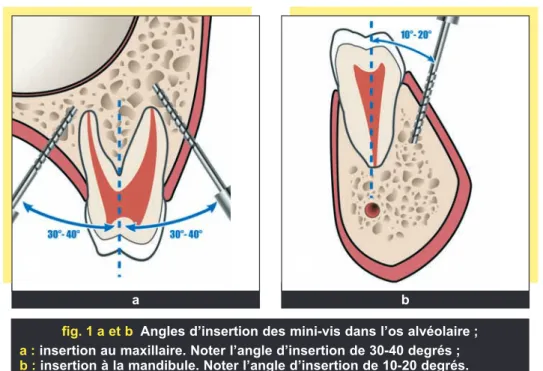 fig. 1 a et b Angles d’insertion des mini-vis dans l’os alvéolaire ; a : insertion au maxillaire