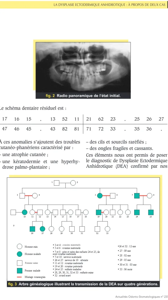 fig. 3 Arbre généalogique illustrant la transmission de la DEA sur quatre générations.