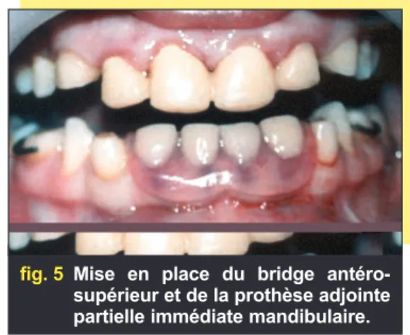 fig. 6 Forme conique des dents rési-