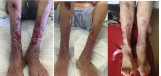 Figure 5. Évolution de la lésion de calciphylaxie des deux jambes : a)  Deux mois après l’admission au service de néphrologie ; b) à la sortie,  cinq mois après l’admission; c) Un an de suivi