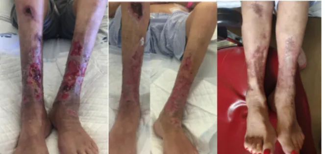 Figure 5. Evolution of calciphylaxis lesion of both legs: a) Two months  after  admission  at  Nephrology  department;  b)  At  discharge,  five  months after admission; c) One year follow-up